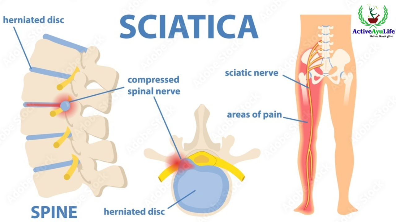 What is Sciatic Pain?
