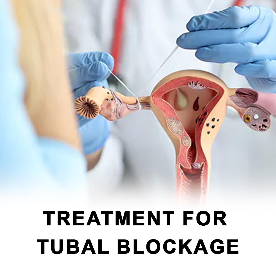 Tubal Blockage Naturally Treatment 