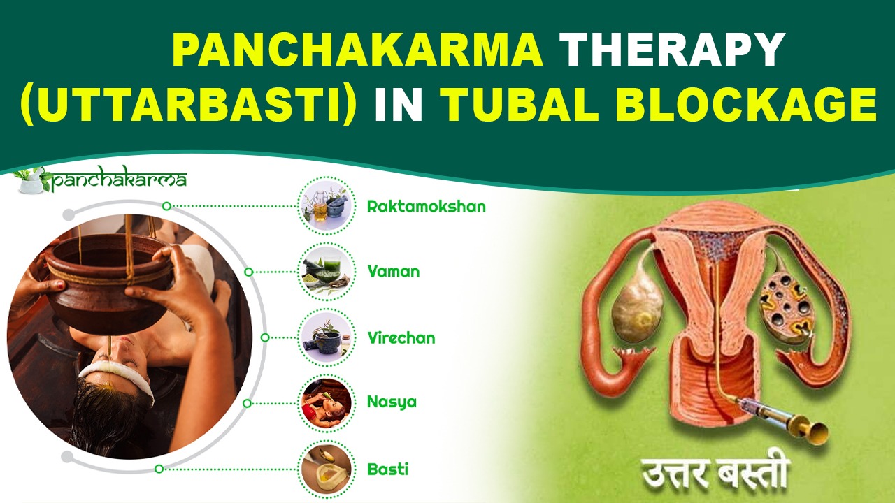 Panchakarma Therapy (Uttar Basti) in Tubal Blockage