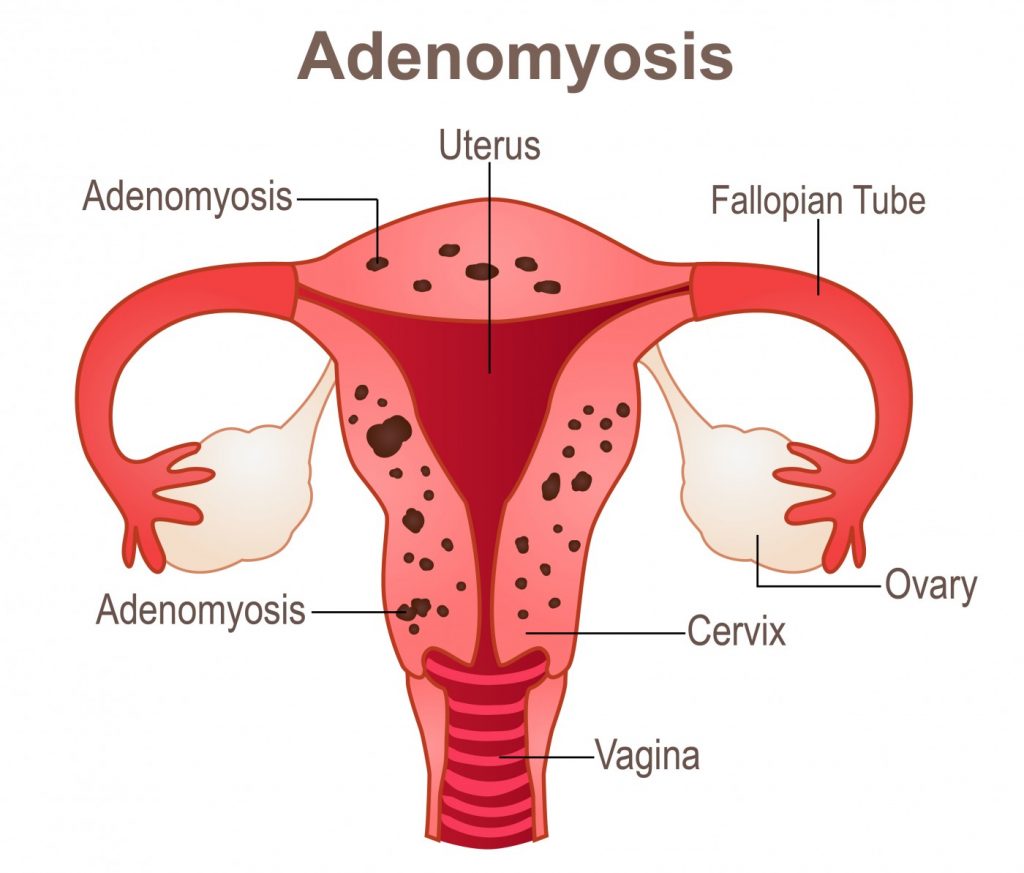 Adenomyosis Ayurvedic Treatment in Delhi