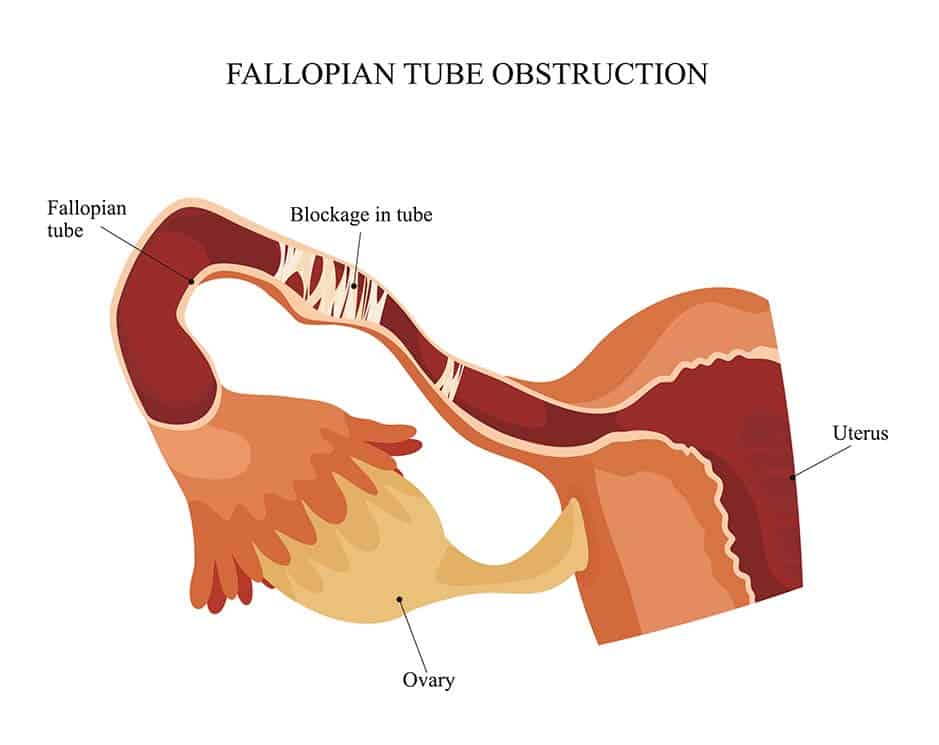 best tubal blockage treatment