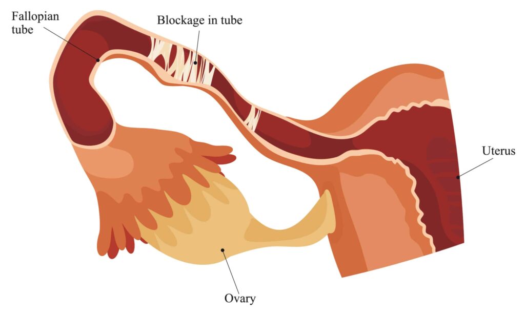 Symptoms of Blocked Fallopian Tubes