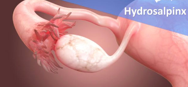 Hydrosalpinx treatment in delhi 